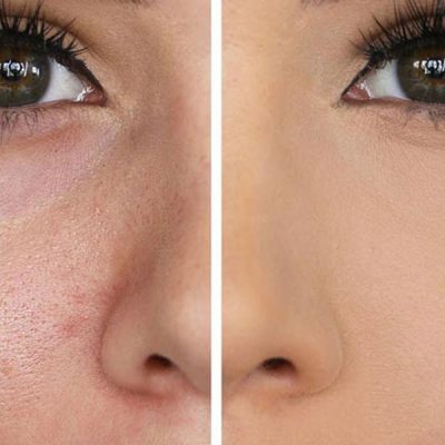 راز بستن منافذ پوستی